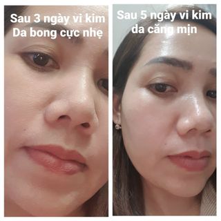 Kem Vi Kim Sinh Học Puderma: Tái tạo da, phá Nám không xâm lấn, không sưng đỏ, hiệu quả sau 3 ngày