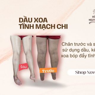DẦU XOA BÓP TĨNH MẠCH CHI-hỗ trợ giảm các triệu chứng suy giãn tĩnh mạch chi🦵