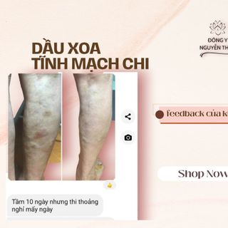 DẦU XOA BÓP TĨNH MẠCH CHI-hỗ trợ giảm các triệu chứng suy giãn tĩnh mạch chi🦵