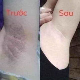 ĐẶC TRỊ HÔI NÁCH TKH