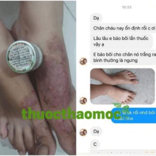 VIÊM DA CƠ ĐỊA TKH