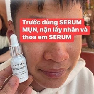 SERUM MỤN SÂM NGỌC LINH TKH