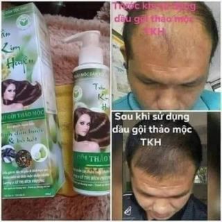 COMBO TRỊ NẤM DA ĐẦU TKH