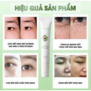Kem bơ mụn thịt, làm mờ nếp nhăn, giảm quầng thâm và bọng mắt