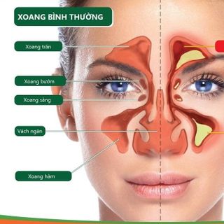 Viên Uống Thảo Dược Xoang Bát Vị - Giảm Triệu Chứng Viêm Xoang, Viêm Mũi, Chảy Nước Mũi, Ngạt Mũi
