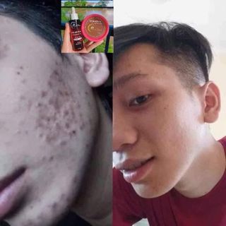 Sỉ Combo 3 Chai LINH CHI VI MỤN - [Mẫu mới] của Công ty Mỹ Phẩm Thanh Trang