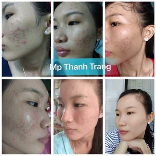 Sỉ Combo 3 Chai LINH CHI VI MỤN - [Mẫu mới] của Công ty Mỹ Phẩm Thanh Trang