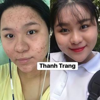 Sỉ Combo 3 Chai LINH CHI VI MỤN - [Mẫu mới] của Công ty Mỹ Phẩm Thanh Trang