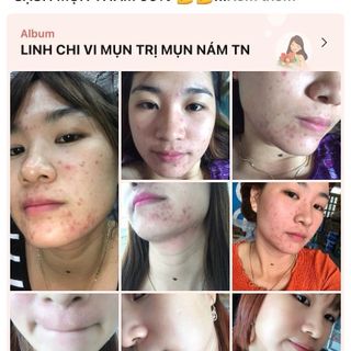 Sỉ Combo 3 Chai LINH CHI VI MỤN - [Mẫu mới] của Công ty Mỹ Phẩm Thanh Trang