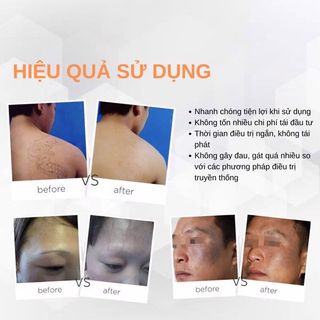 Máy xóa xăm ND YAG laser RY580