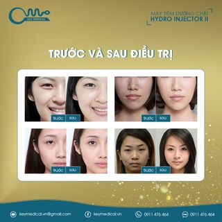 Máy tiêm dưỡng chất HYDRO INJECTOR II