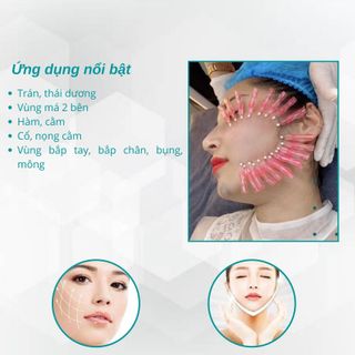 Chỉ Làm đầy và trẻ hoá da PDO Screw: 29*40mm