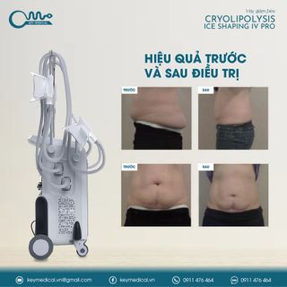 Máy giảm béo 4 tay cầm cryolipolysis (IS4)