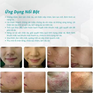 Máy phi kim điều trị sẹo RF Fractional Microdermabrasion TB8811B