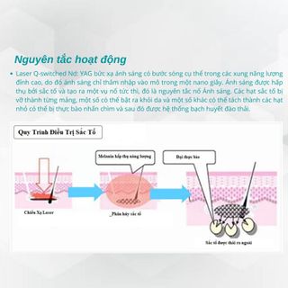 Máy điều trị nám, xoá xăm 1064QGH02 công nghệ Q-Switched Nd:YAG