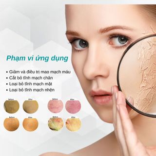 Máy xóa mao mạch máu, tĩnh mạch sóng RF cao tần SHF-1