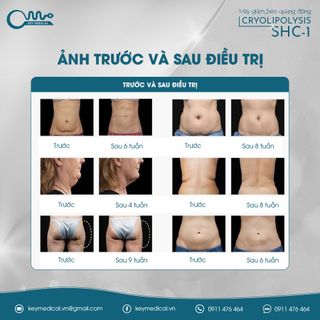 Máy giảm béo quang đông Cryolipolysis SHC-1