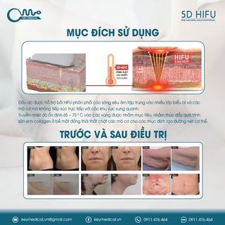 Máy nâng cơ 5D HIFU (SMASFOCUS III)