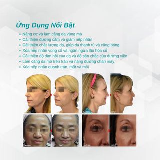 Máy nâng cơ Hifu công nghệ sóng siêu âm cường độ cao HF05