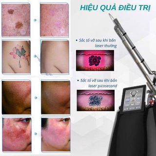 Máy trị nám 850ps picosecond laser (PS II)