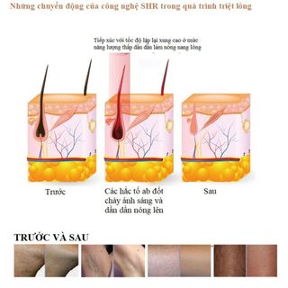 Máy triệt lông cầm tay IPL (NBW-SHR213)