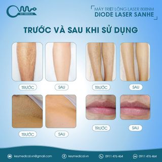 Máy triệt lông laser 808nm Diode laser Sanhe