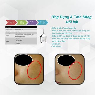 Máy Điều Trị Nám, Sắc Tố ACTIVO Q-SWITCHED ND-YAG