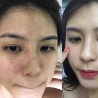 Kem Hàn Quốc trị nám, thâm, trắng da cấp tốc chính hãng