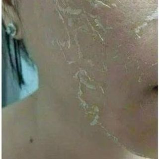 PEEL DA VI TẢO retinol CAO CẤP tẩy da chết giảm mụn thâm nám tàn nhang thay da sinh học Giúp loại bỏ tế bào chết bên ngoài