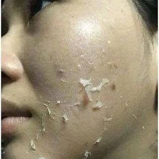 PEEL DA VI TẢO retinol CAO CẤP tẩy da chết giảm mụn thâm nám tàn nhang thay da sinh học Giúp loại bỏ tế bào chết bên ngoài