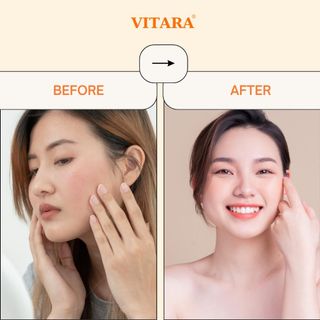 Gel thoa mụn Vitara Anti Acne làm lành vết thương do mụn, ngừa thâm mụn 10g chính hãng Thái Lan
