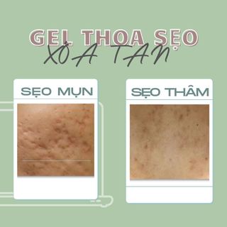 Kem mờ sẹo Vitara SE gel thoa sẹo thâm rỗ giảm quá trình hình thành sẹo, mờ sẹo thâm, sẹo mụn 5g hoặc 15g