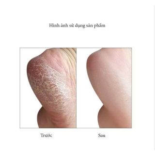 DỤNG CỤ CHÀ GÓT CHÂN