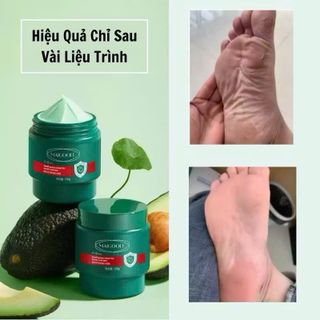 Kem nứt gót chân