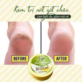 Nứt gót chân Banana
