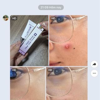 Kem Mụn Neré Derma Clear Acne Cream 5g Hỗ Trợ Giảm Mụn Làm Dịu Da Cho Da Mụn