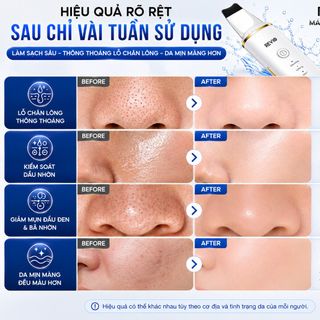 Máy chà mụn đầu đen công nghệ ion+- đẩy mụn sâu