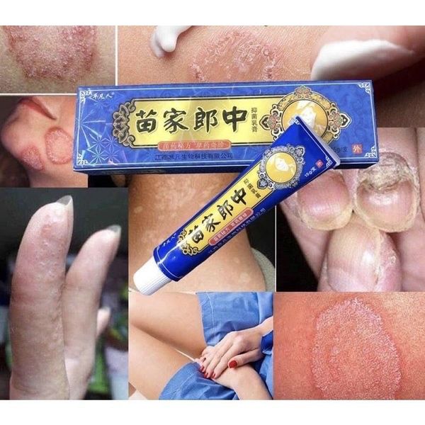 Kem thảo dược bôi ngoài da: nứt nẻ, nấm ngứa, vảy nến, á sừng cực kỳ hiệu quả - CTB798 Kem thảo dược bôi ngoài da: nứt nẻ, nấm ngứa, vảy nến, á sừng cực kỳ hiệu quả - CTB798